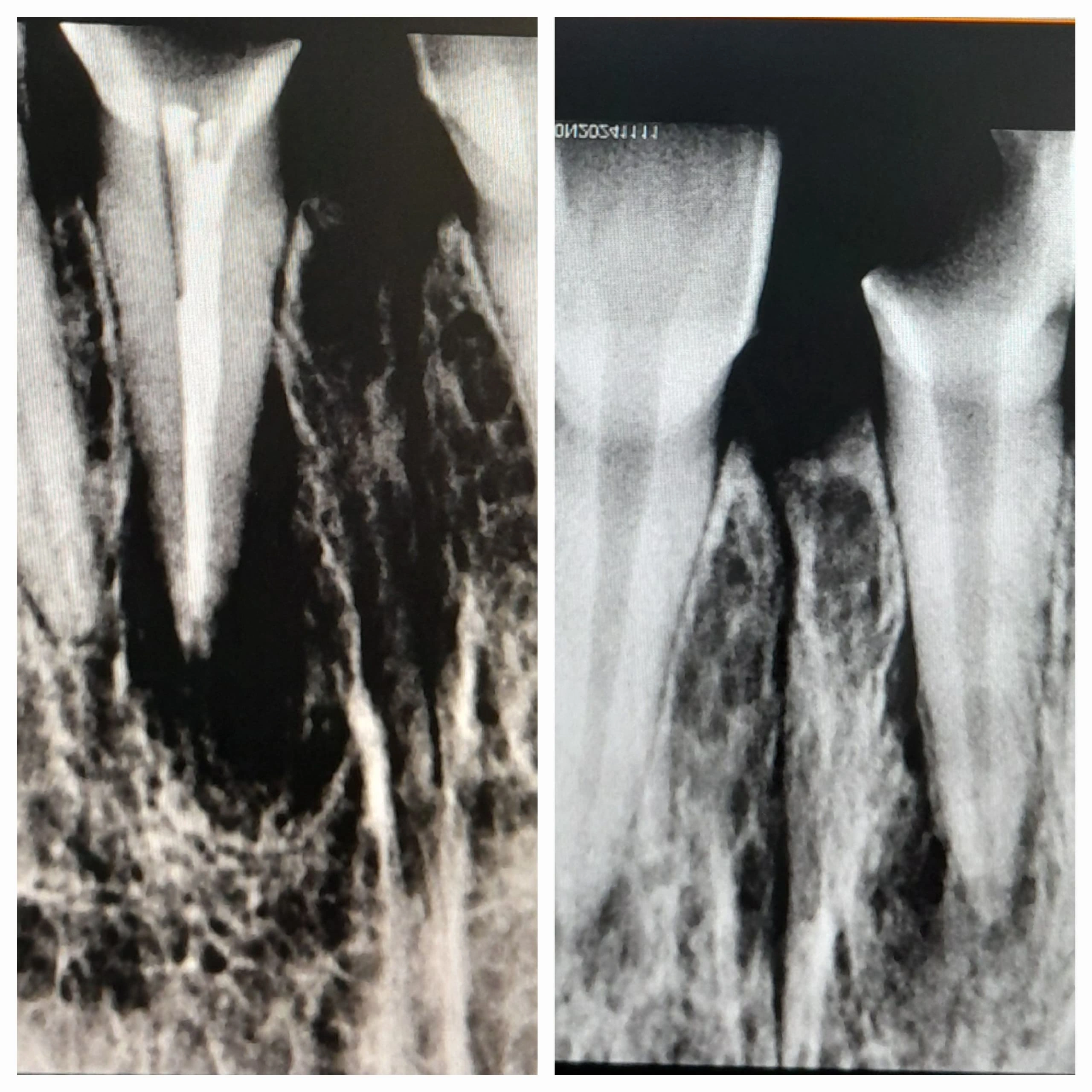 Dental Treatment done at Sterling Dental Clinic